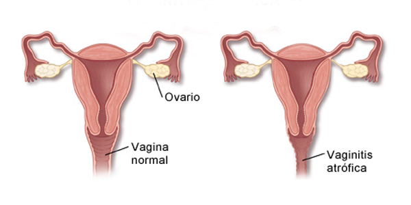 ¿CÓMO AFECTA LA ATROFIA VAGINAL POSTMENOPÁUSICA?