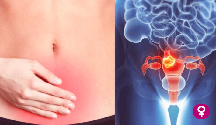 Principal causas de Cáncer de Cuello uterino 