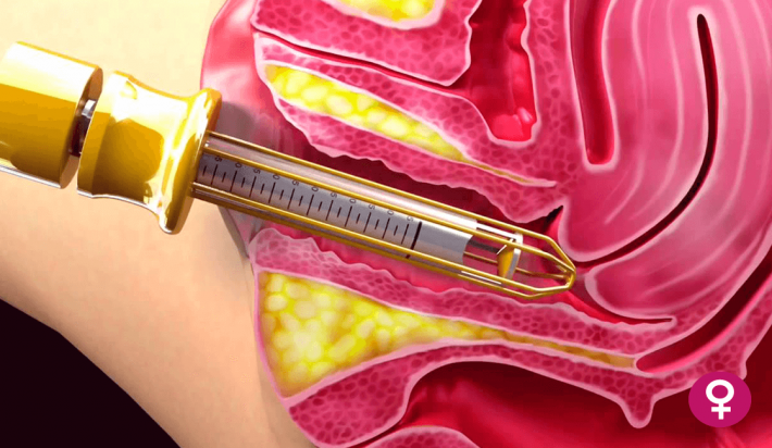 Tratamiento con vaporización de Condilomas genitales