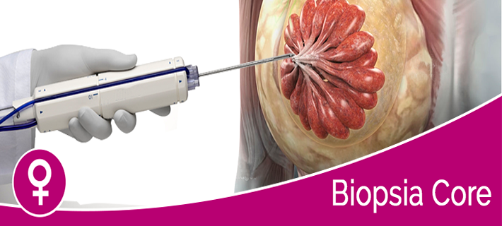 Biopsia core, un diagnóstico innovador para prevenir el cáncer de mama