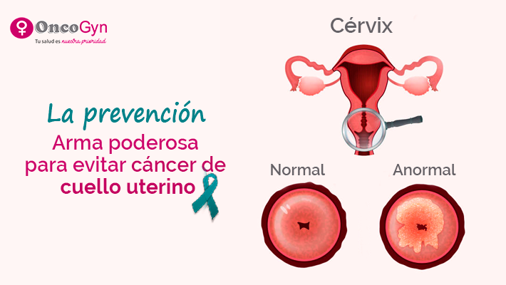 cáncer de cuello uterino