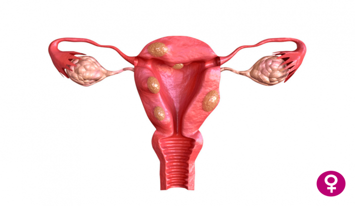 Qué es un mioma uterino y sus consecuencias