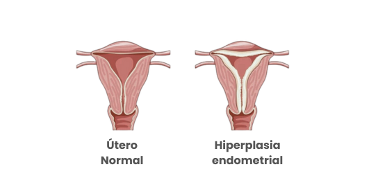 Hiperplasia Endometrial – Síntomas y detección