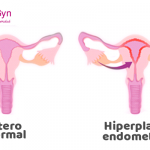 Hiperplasia Endometrial – Síntomas y detección – Copy