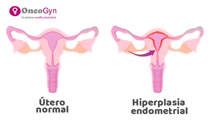 Hiperplasia Endometrial – Síntomas y detección