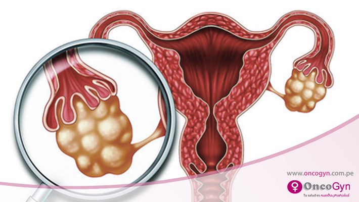 Relación entre el Síndrome de Ovario Poliquístico y resistencia a la insulina