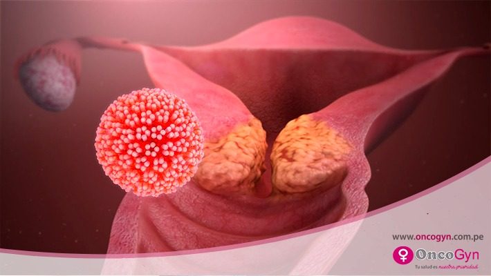 VIRUS DEL PAPILOMA HUMANO
