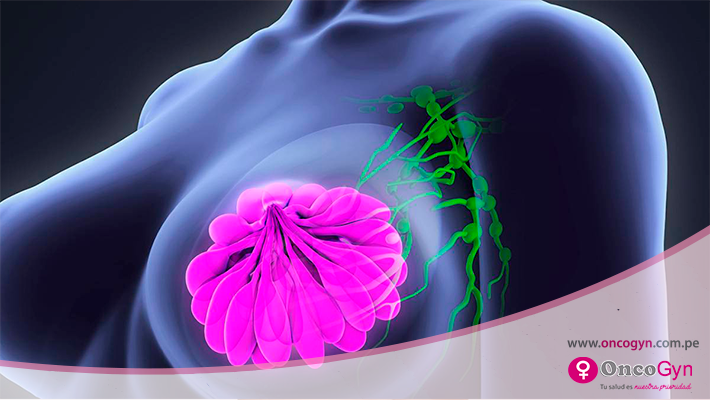 Biopsia Core en lesiones mamarias para la detección de cáncer de mama precoz