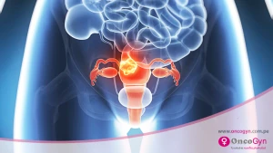 Miomas uterinos, una patología benigna frecuente en las mujeres