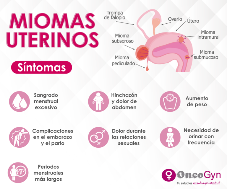 Miomas Uterinos, Una Patología Benigna Frecuente En Las Mujeres