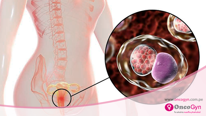 cervicitis