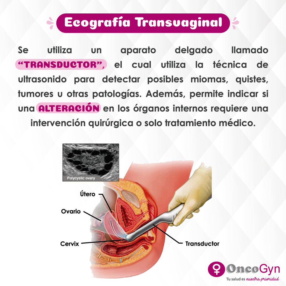 Pólipos Uterinos: ¿Cómo puedo detectarlos y qué tratamiento puedo realizarme? Pólipos Uterinos: ¿Cómo puedo detectarlos y qué tratamiento puedo realizarme?